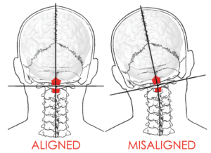 mis-aligned spine 